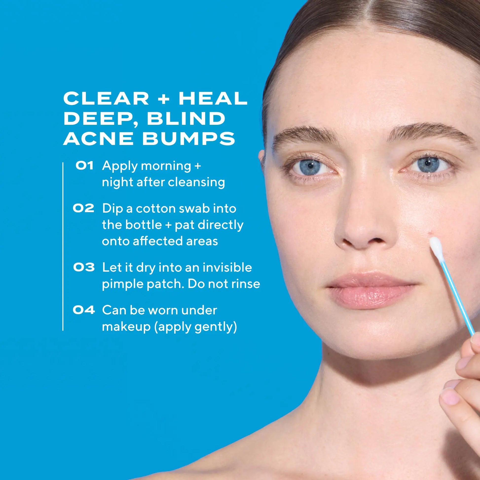 Murad Deep Relief Acne Treatment - 2% Salicylic Acid & Advanced Phytosteroid Technology for Rapid Acne Healing and Skin Restoration