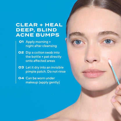 Murad Deep Relief Acne Treatment - 2% Salicylic Acid & Advanced Phytosteroid Technology for Rapid Acne Healing and Skin Restoration