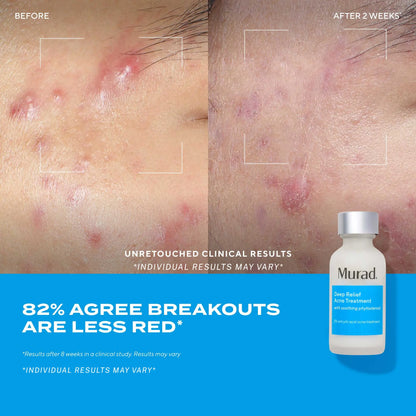 Murad Deep Relief Acne Treatment - 2% Salicylic Acid & Advanced Phytosteroid Technology for Rapid Acne Healing and Skin Restoration