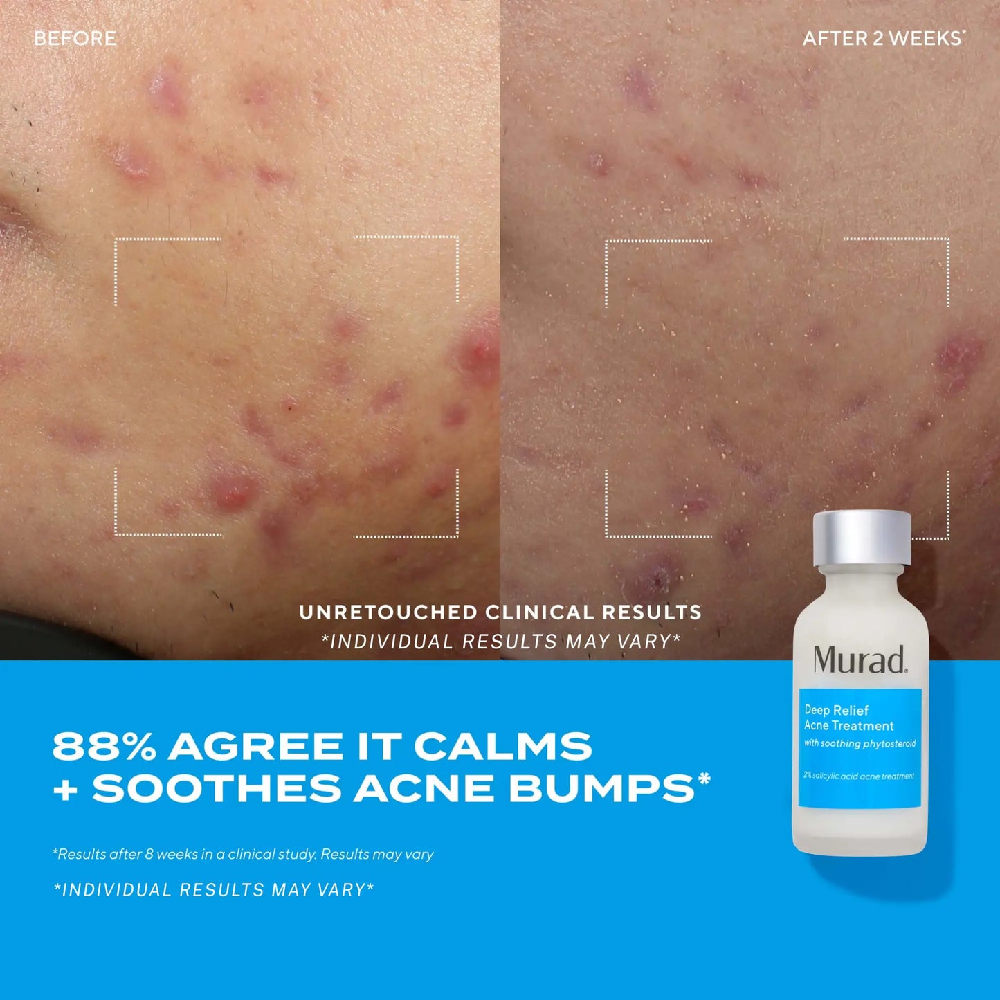 Murad Deep Relief Acne Treatment - 2% Salicylic Acid & Advanced Phytosteroid Technology for Rapid Acne Healing and Skin Restoration